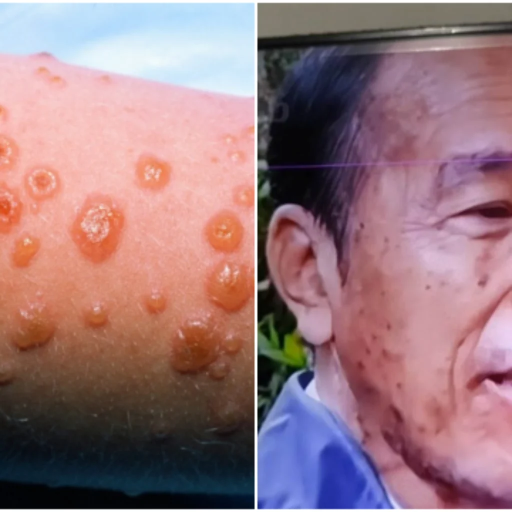 Jokowi Diisukan Derita Sindrom SJS: Bisa Disebabkan oleh Obat Antikejang, Ini Gejala dan Bahayanya