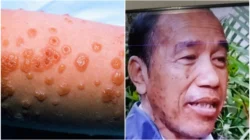 Jokowi Diisukan Derita Sindrom SJS: Bisa Disebabkan oleh Obat Antikejang, Ini Gejala dan Bahayanya