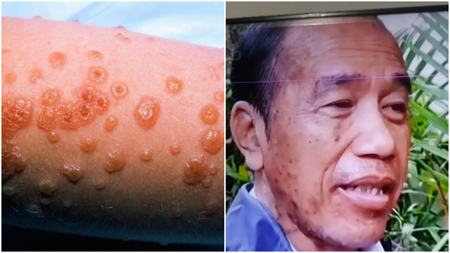 Jokowi Diisukan Derita Sindrom SJS: Bisa Disebabkan oleh Obat Antikejang, Ini Gejala dan Bahayanya